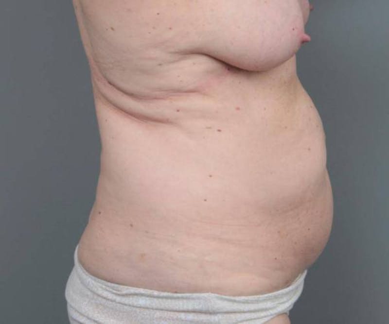 Tummy Tuck Before & After Gallery - Patient 367679 - Image 5 - Scott Chapin, MD