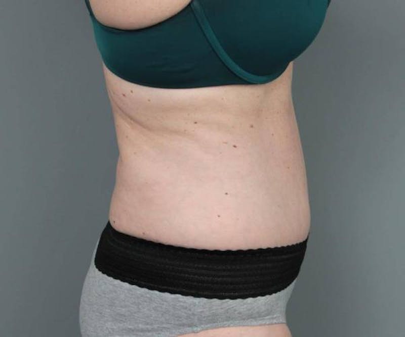 Tummy Tuck Before & After Gallery - Patient 367679 - Image 6 - Scott Chapin, MD