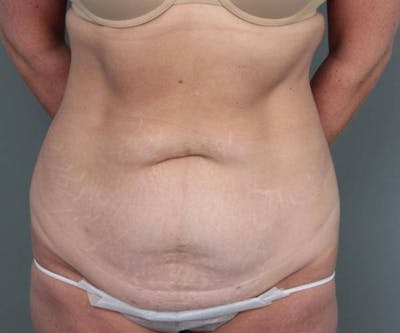 Tummy Tuck Before & After Gallery - Patient 371571 - Image 1 - Scott Chapin, MD