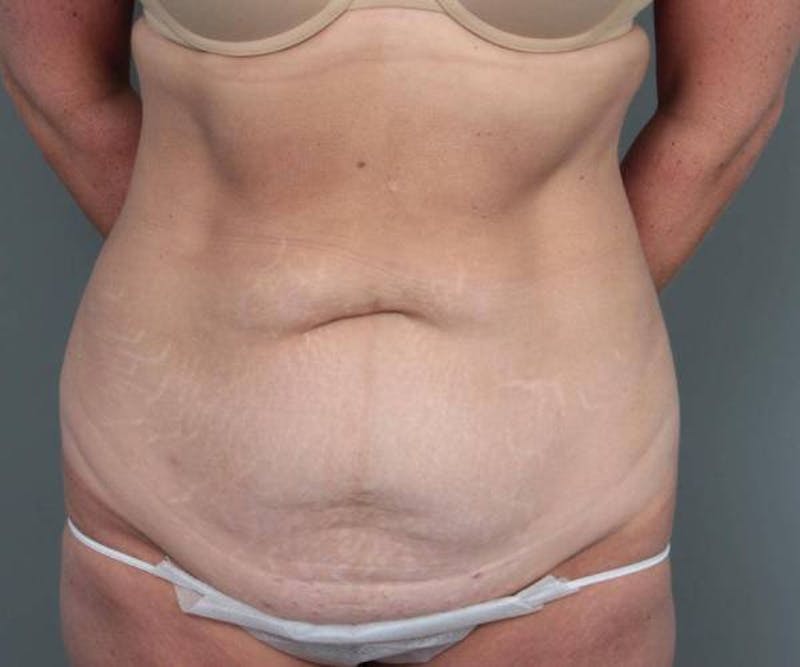 Tummy Tuck Before & After Gallery - Patient 371571 - Image 1 - Scott Chapin, MD