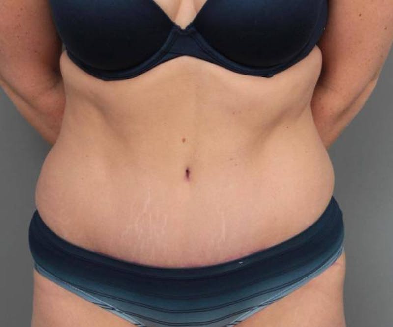 Tummy Tuck Before & After Gallery - Patient 371571 - Image 2 - Scott Chapin, MD