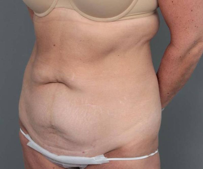 Tummy Tuck Before & After Gallery - Patient 371571 - Image 3 - Scott Chapin, MD