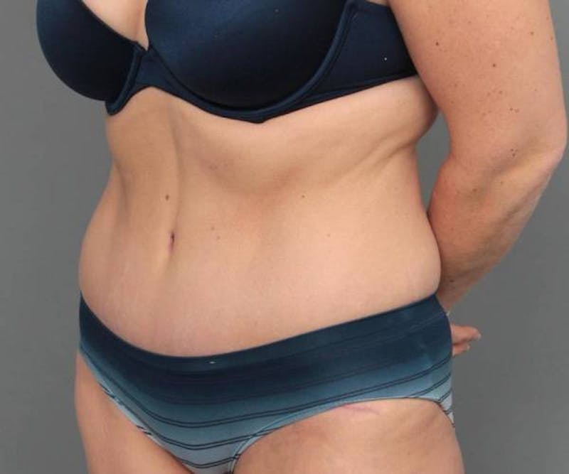 Tummy Tuck Before & After Gallery - Patient 371571 - Image 4 - Scott Chapin, MD