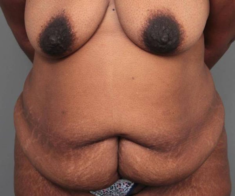 Tummy Tuck Before & After Gallery - Patient 814549 - Image 1 - Scott Chapin, MD
