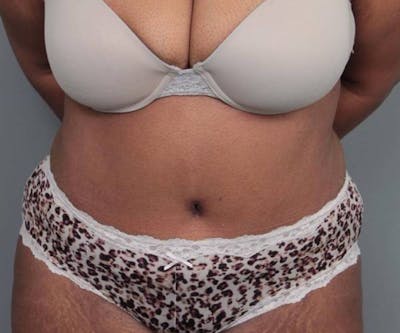 Tummy Tuck Before & After Gallery - Patient 814549 - Image 2 - Scott Chapin, MD
