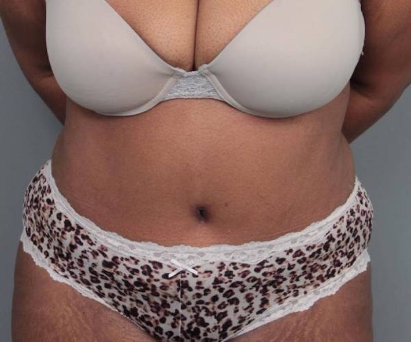Tummy Tuck Before & After Gallery - Patient 814549 - Image 2 - Scott Chapin, MD
