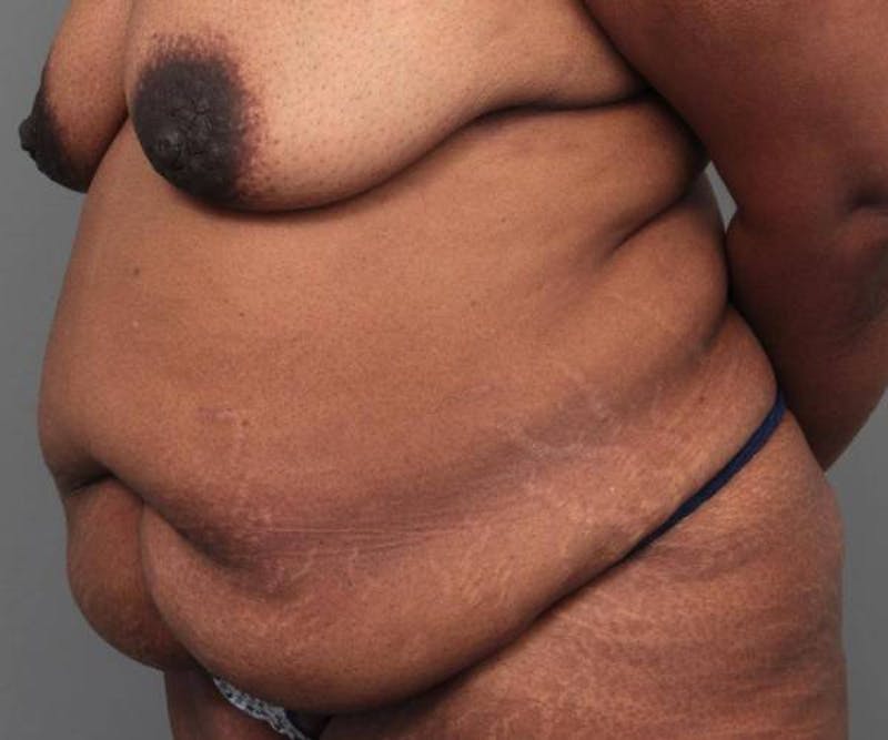Tummy Tuck Before & After Gallery - Patient 814549 - Image 3 - Scott Chapin, MD