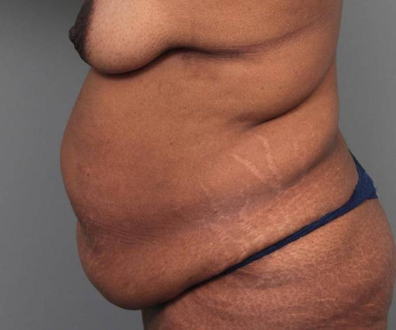 Tummy Tuck Before & After Gallery - Patient 814549 - Image 5 - Scott Chapin, MD