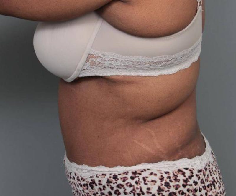Tummy Tuck Before & After Gallery - Patient 814549 - Image 6 - Scott Chapin, MD