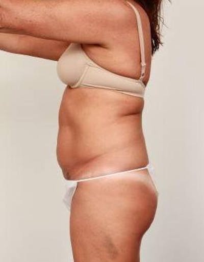 Tummy Tuck Before & After Gallery - Patient 178164 - Image 1 - Scott Chapin, MD