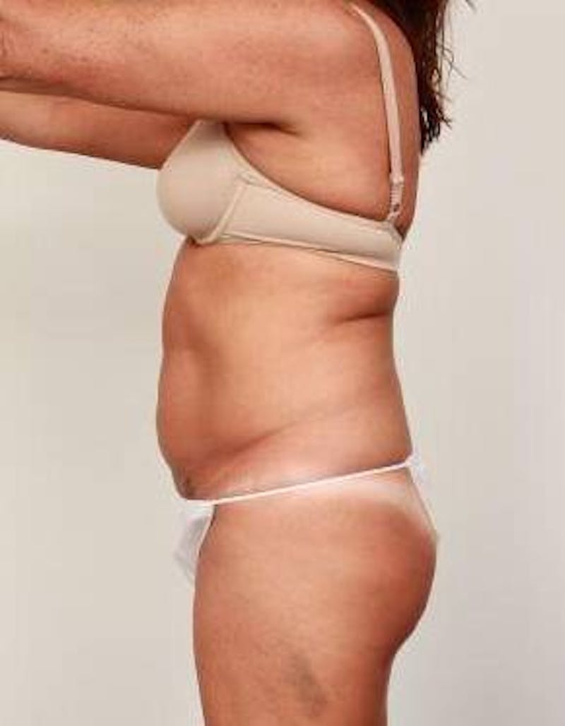 Tummy Tuck Before & After Gallery - Patient 178164 - Image 1 - Scott Chapin, MD