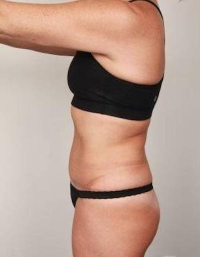 Tummy Tuck Before & After Gallery - Patient 178164 - Image 2 - Scott Chapin, MD