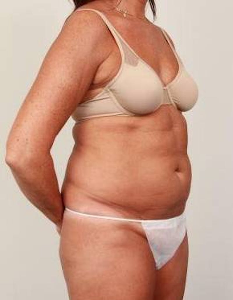 Tummy Tuck Before & After Gallery - Patient 178164 - Image 3 - Scott Chapin, MD