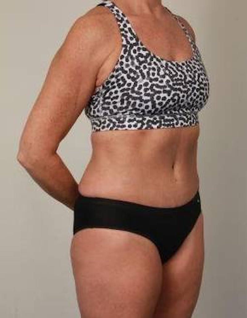 Tummy Tuck Before & After Gallery - Patient 178164 - Image 4 - Scott Chapin, MD
