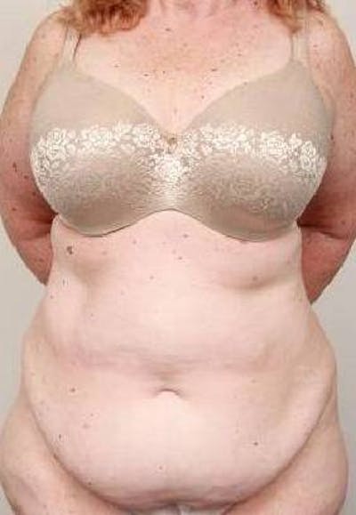 Tummy Tuck Before & After Gallery - Patient 361139 - Image 1 - Scott Chapin, MD