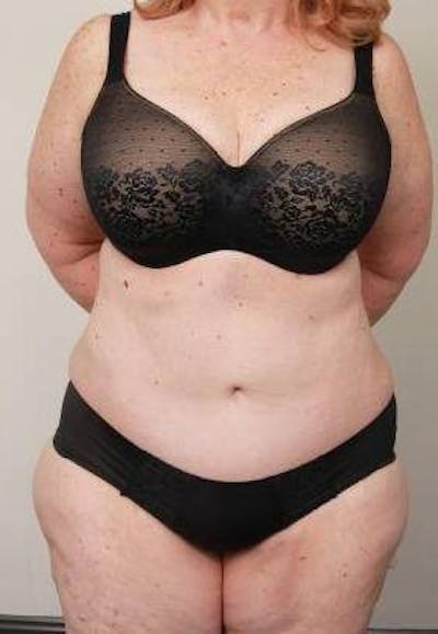 Tummy Tuck Before & After Gallery - Patient 361139 - Image 2 - Scott Chapin, MD