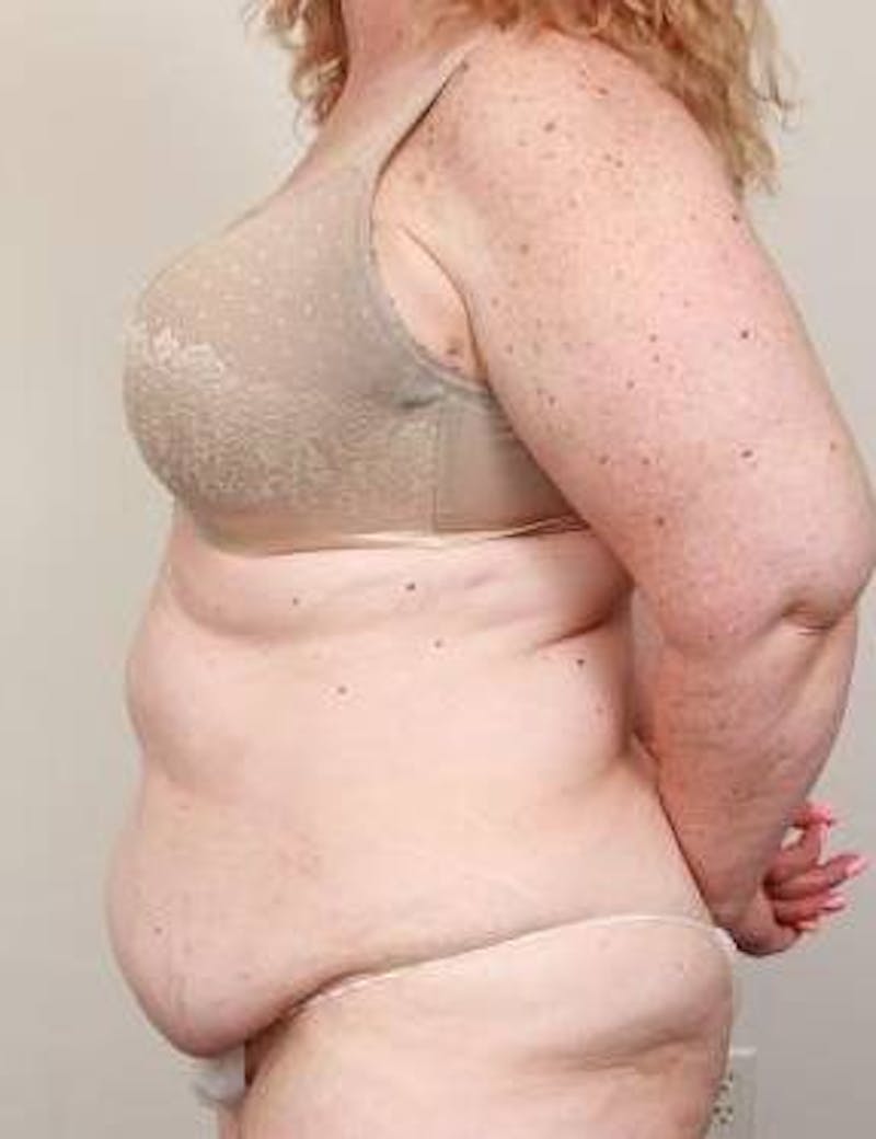 Tummy Tuck Before & After Gallery - Patient 361139 - Image 3 - Scott Chapin, MD