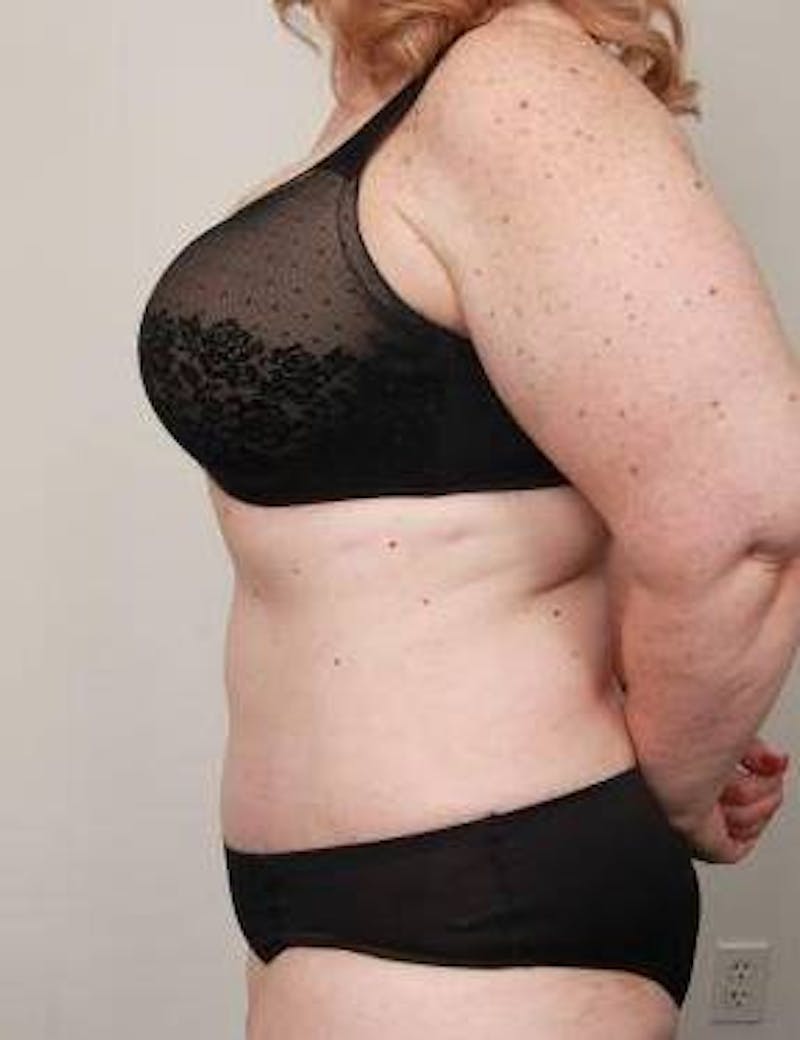 Tummy Tuck Before & After Gallery - Patient 361139 - Image 4 - Scott Chapin, MD