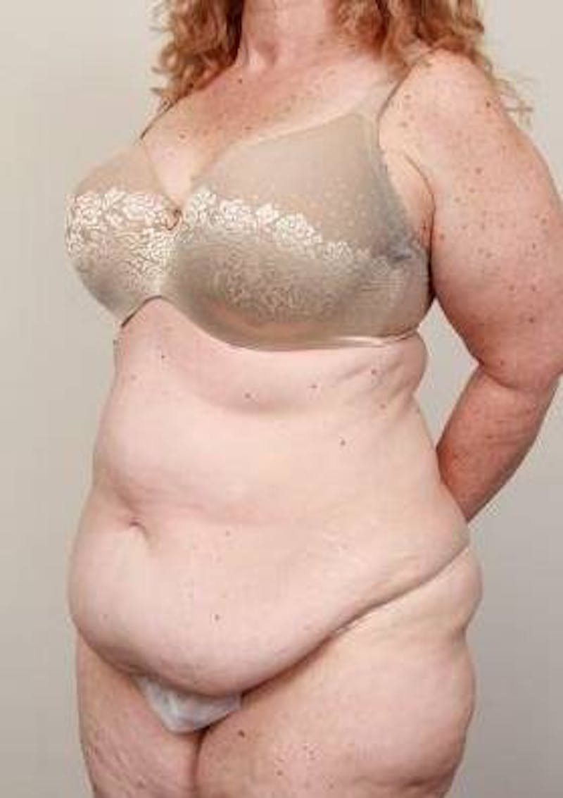 Tummy Tuck Before & After Gallery - Patient 361139 - Image 5 - Scott Chapin, MD