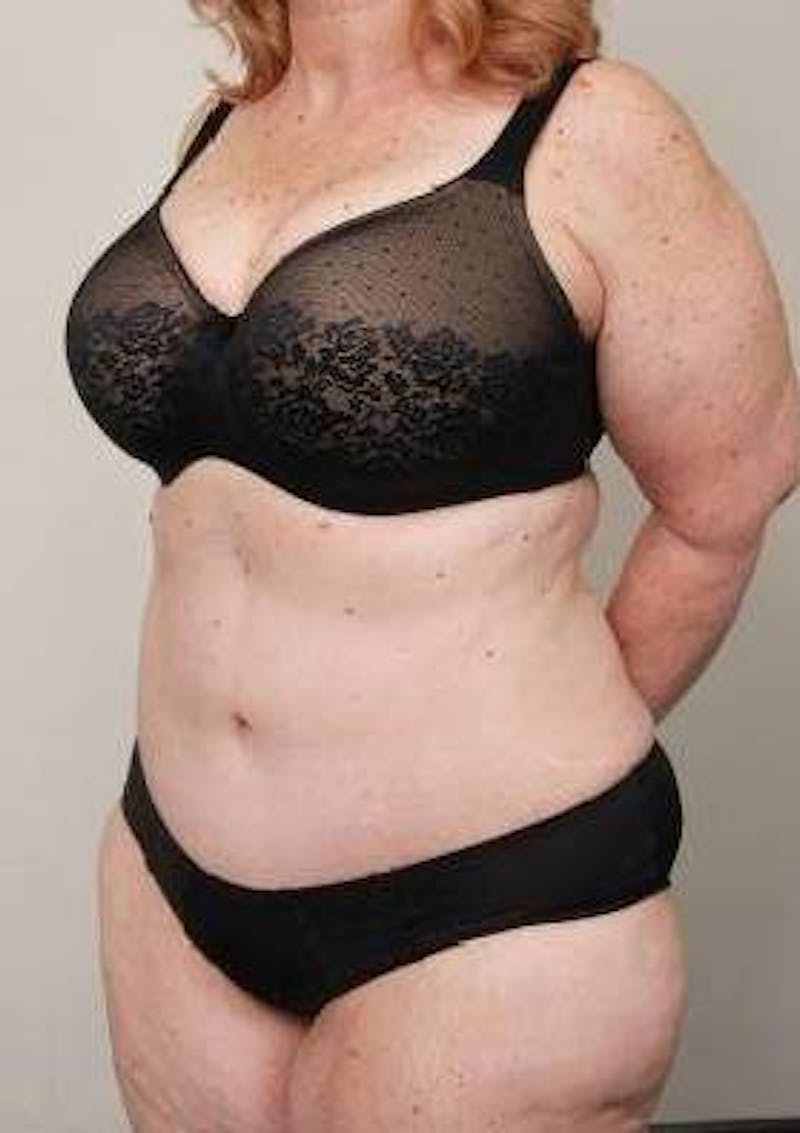 Tummy Tuck Before & After Gallery - Patient 361139 - Image 6 - Scott Chapin, MD