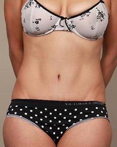 Tummy Tuck Before & After Gallery - Patient 322966 - Image 2 - Scott Chapin, MD