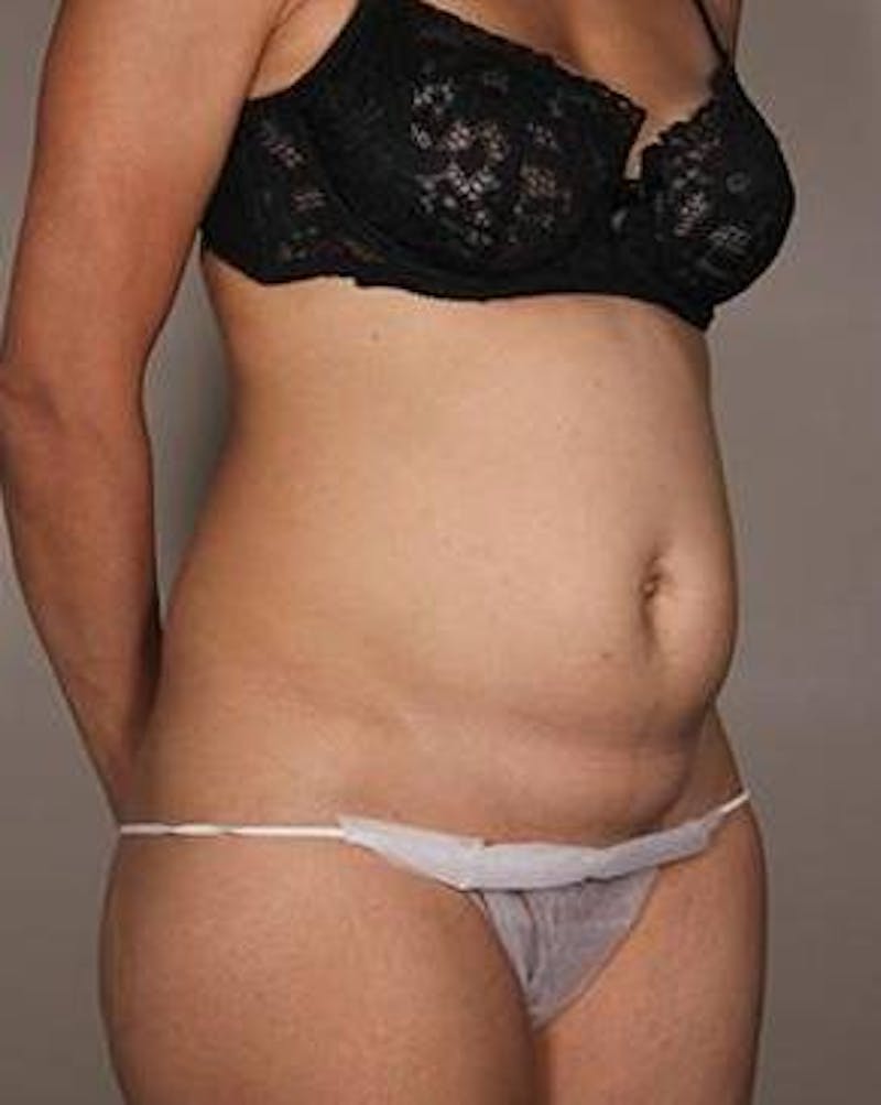 Tummy Tuck Before & After Gallery - Patient 322966 - Image 5 - Scott Chapin, MD