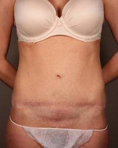 Tummy Tuck Before & After Gallery - Patient 198525 - Image 1 - Scott Chapin, MD