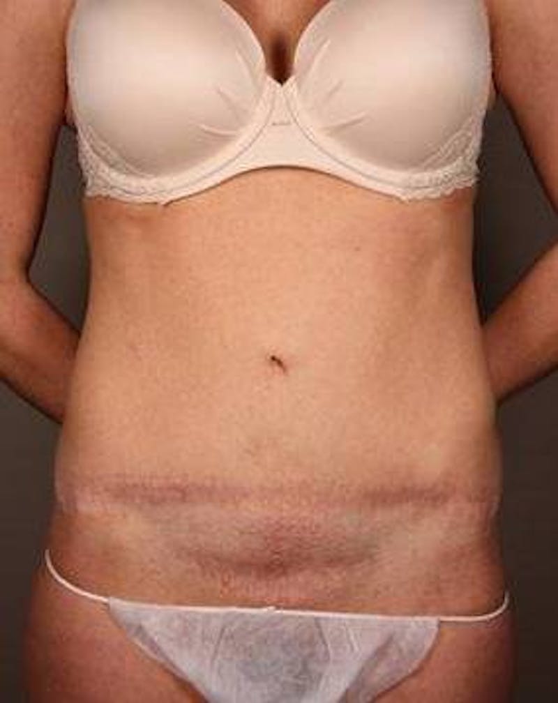 Tummy Tuck Before & After Gallery - Patient 198525 - Image 1 - Scott Chapin, MD