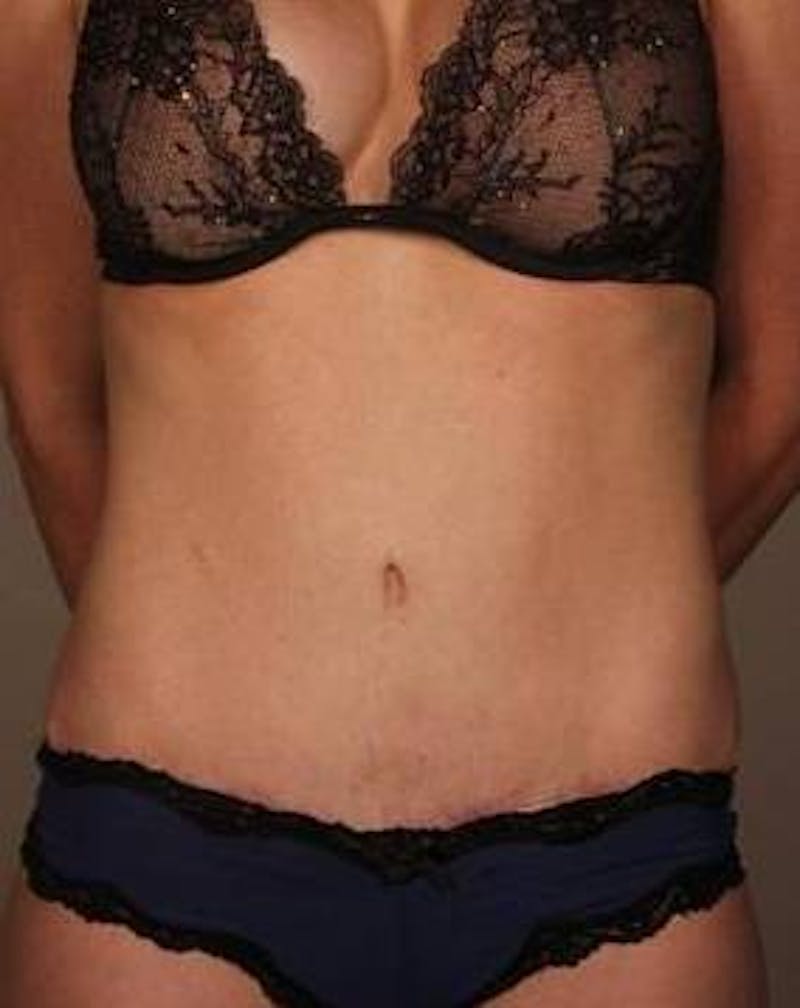 Tummy Tuck Before & After Gallery - Patient 198525 - Image 2 - Scott Chapin, MD