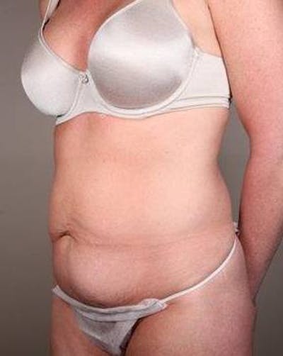 Tummy Tuck Before & After Gallery - Patient 315256 - Image 1 - Scott Chapin, MD