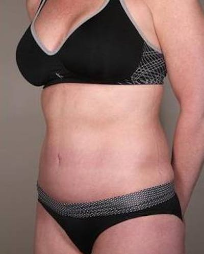 Tummy Tuck Before & After Gallery - Patient 315256 - Image 2 - Scott Chapin, MD