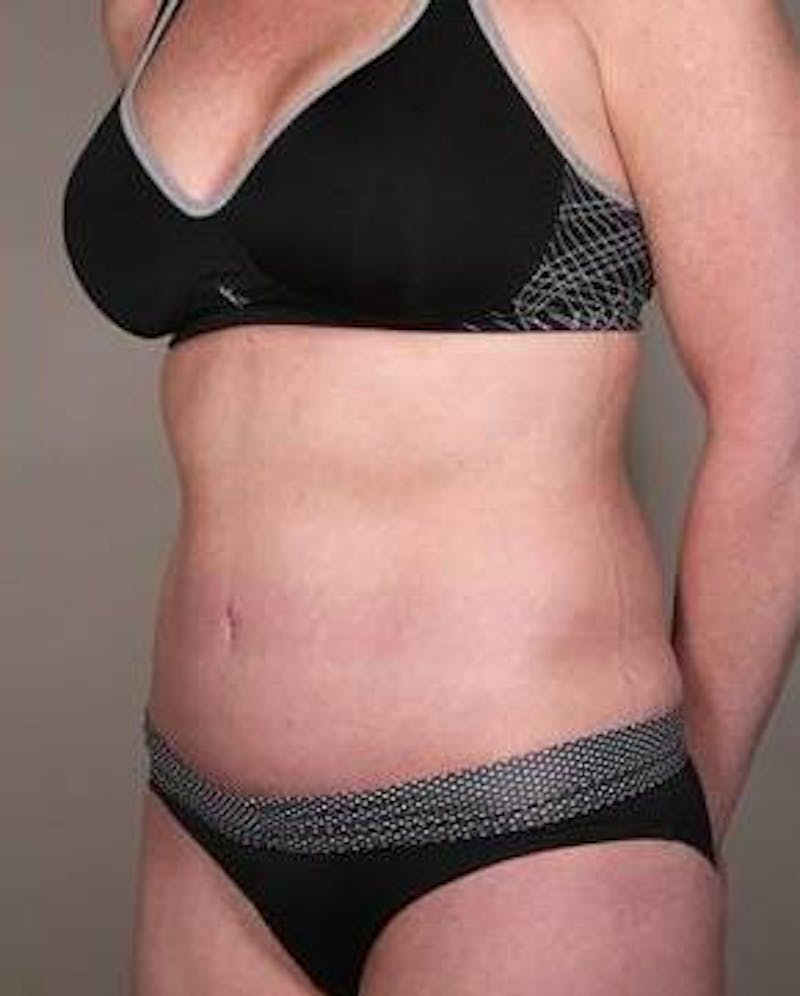 Tummy Tuck Before & After Gallery - Patient 315256 - Image 2 - Scott Chapin, MD