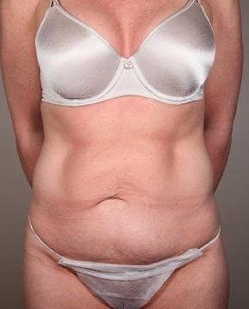 Tummy Tuck Before & After Gallery - Patient 315256 - Image 3 - Scott Chapin, MD