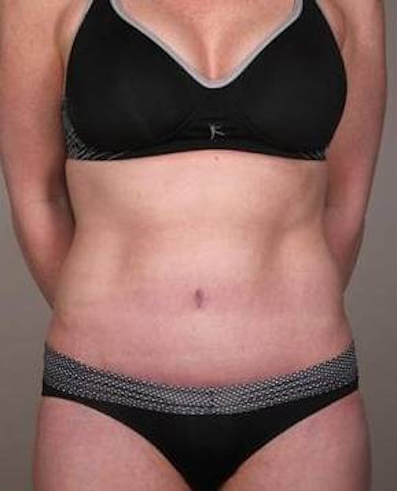Tummy Tuck Before & After Gallery - Patient 315256 - Image 4 - Scott Chapin, MD