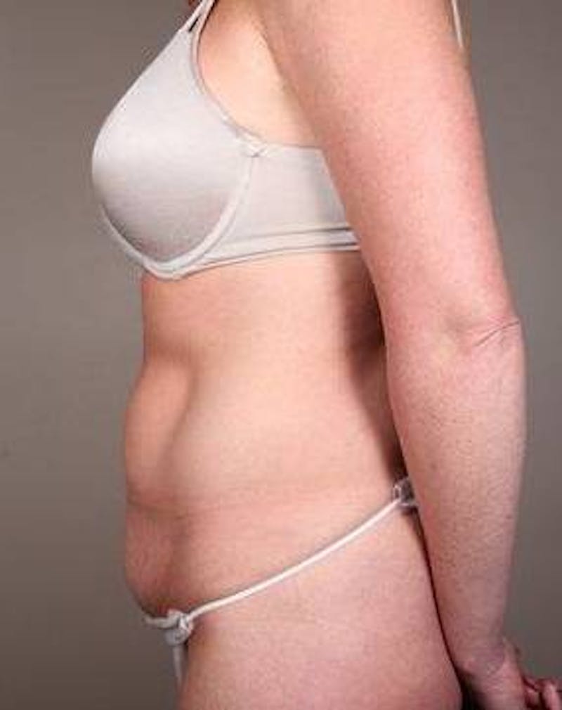 Tummy Tuck Before & After Gallery - Patient 315256 - Image 5 - Scott Chapin, MD