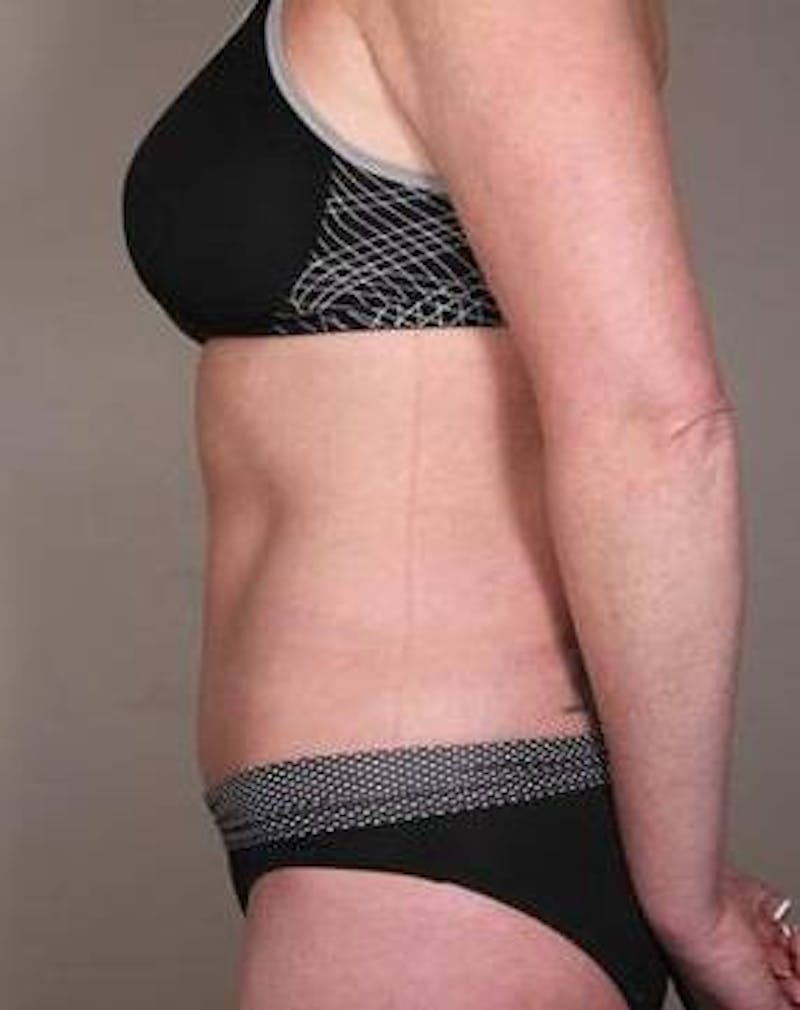Tummy Tuck Before & After Gallery - Patient 315256 - Image 6 - Scott Chapin, MD