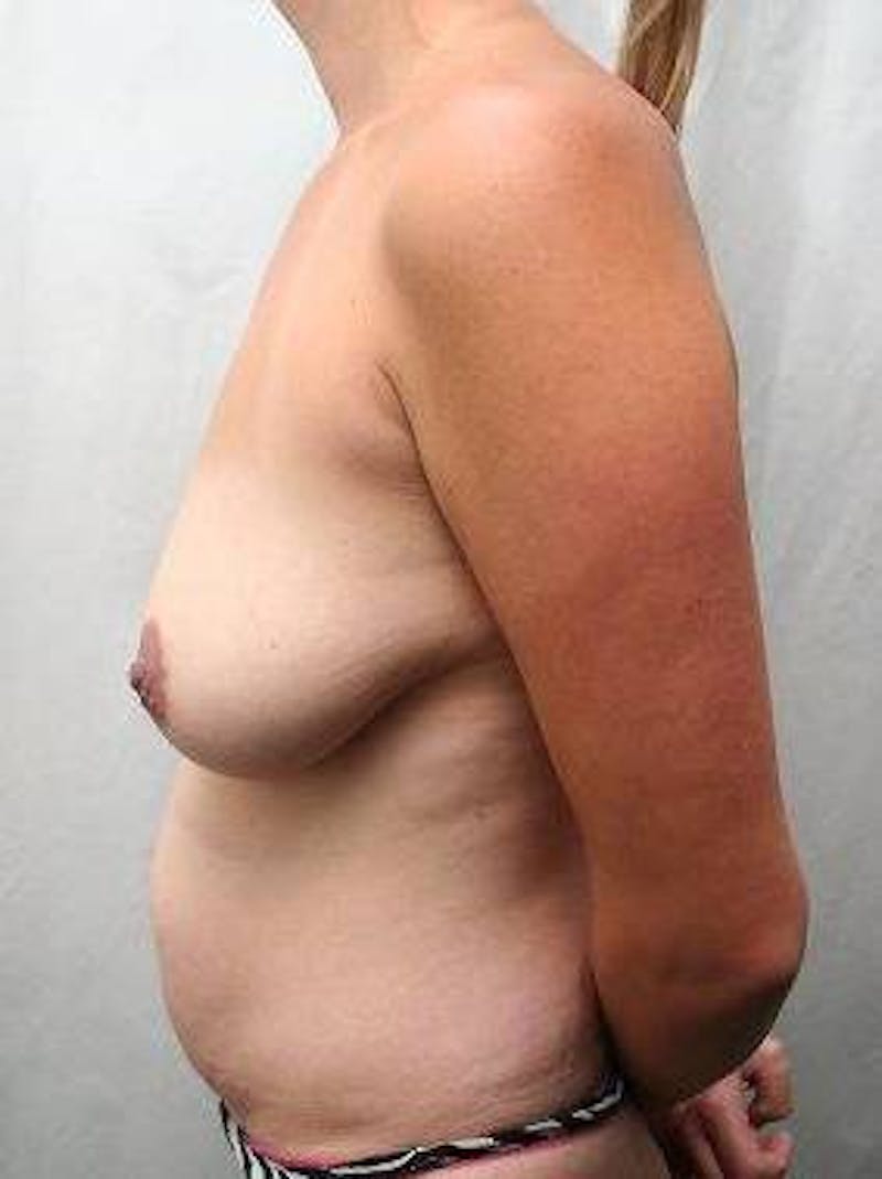 Tummy Tuck Before & After Gallery - Patient 645355 - Image 3 - Scott Chapin, MD