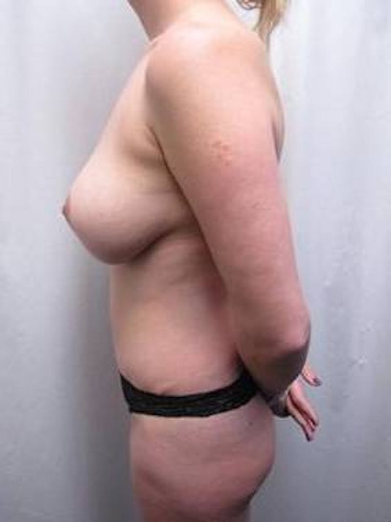 Tummy Tuck Before & After Gallery - Patient 645355 - Image 4 - Scott Chapin, MD