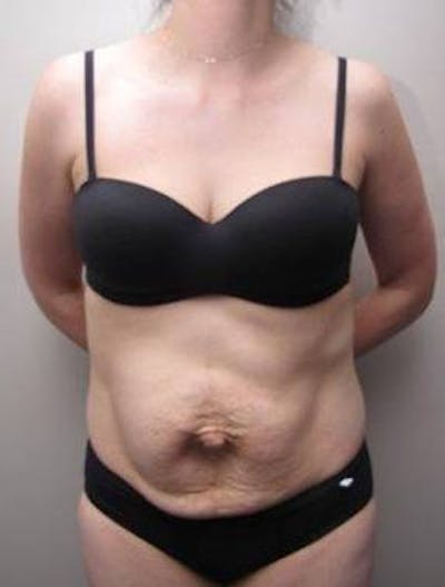 Tummy Tuck Before & After Gallery - Patient 107944 - Image 1 - Scott Chapin, MD