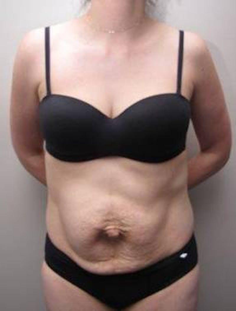 Tummy Tuck Before & After Gallery - Patient 107944 - Image 1 - Scott Chapin, MD