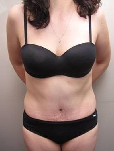 Tummy Tuck Before & After Gallery - Patient 107944 - Image 2 - Scott Chapin, MD