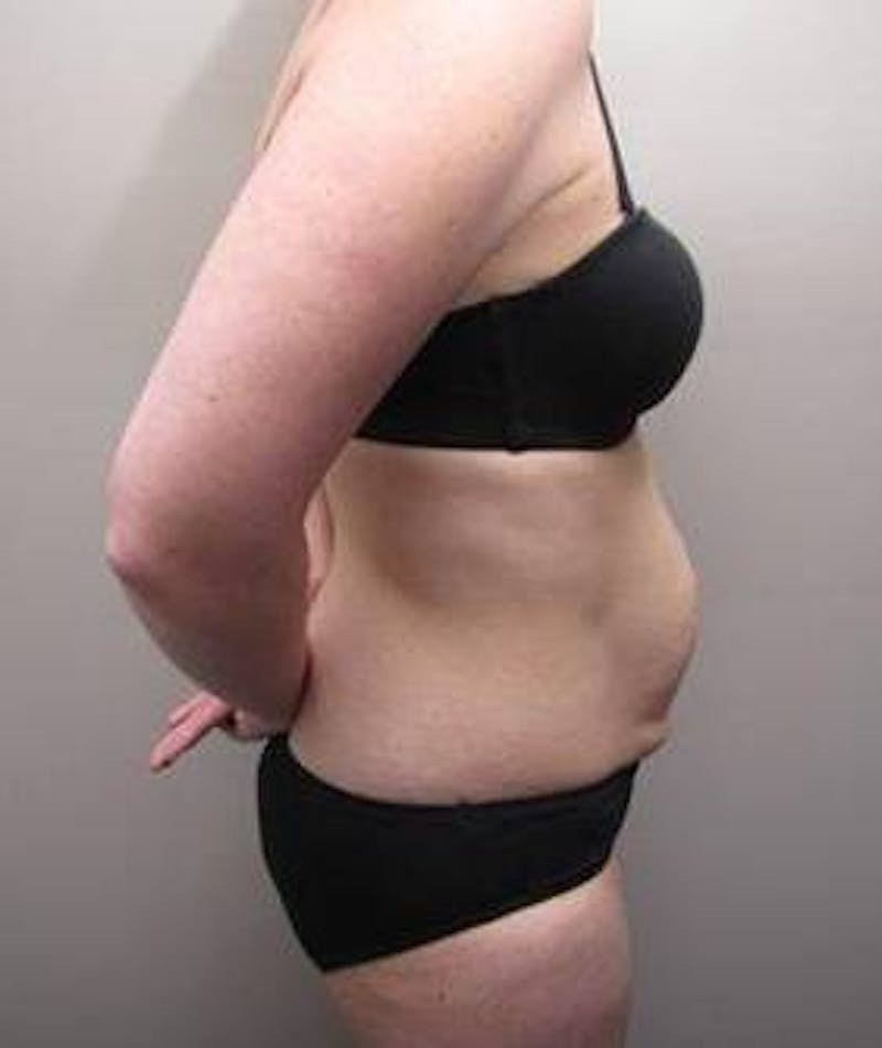 Tummy Tuck Before & After Gallery - Patient 107944 - Image 3 - Scott Chapin, MD