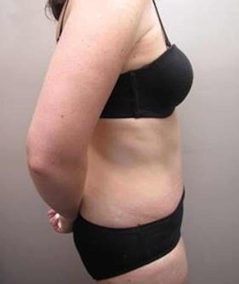 Tummy Tuck Before & After Gallery - Patient 107944 - Image 4 - Scott Chapin, MD