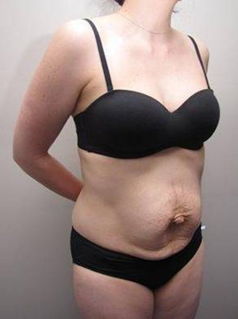 Tummy Tuck Before & After Gallery - Patient 107944 - Image 5 - Scott Chapin, MD