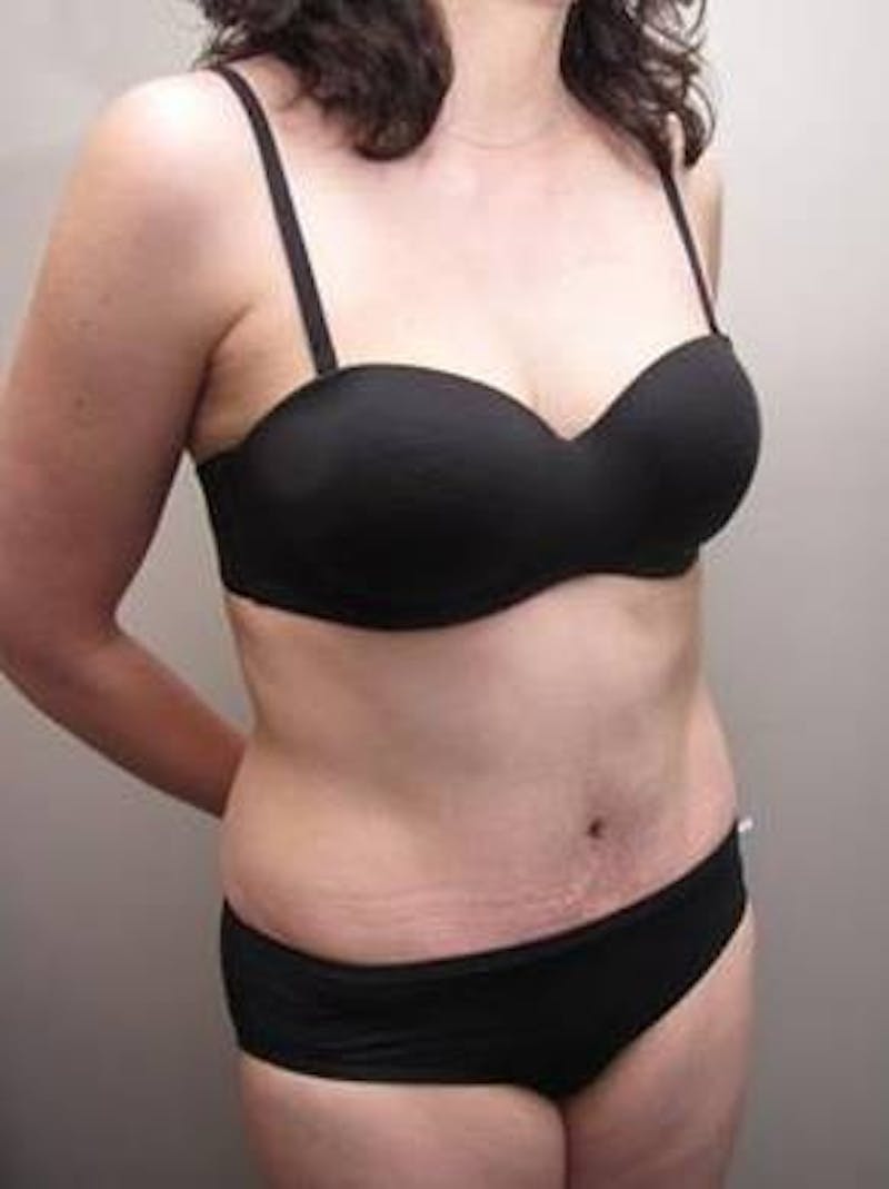 Tummy Tuck Before & After Gallery - Patient 107944 - Image 6 - Scott Chapin, MD