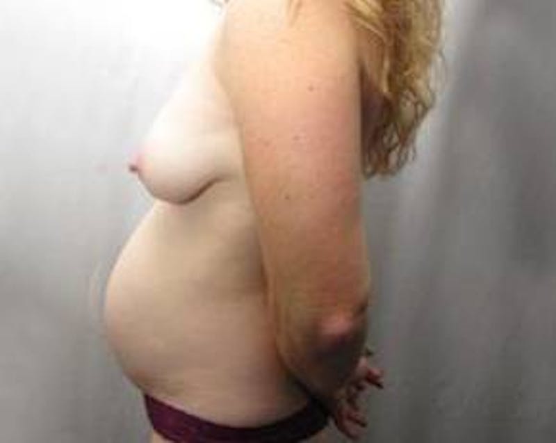 Tummy Tuck Before & After Gallery - Patient 152141 - Image 1 - Scott Chapin, MD