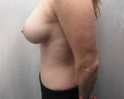Tummy Tuck Before & After Gallery - Patient 152141 - Image 2 - Scott Chapin, MD
