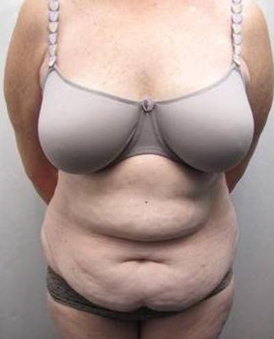 Tummy Tuck Before & After Gallery - Patient 802597 - Image 1 - Scott Chapin, MD