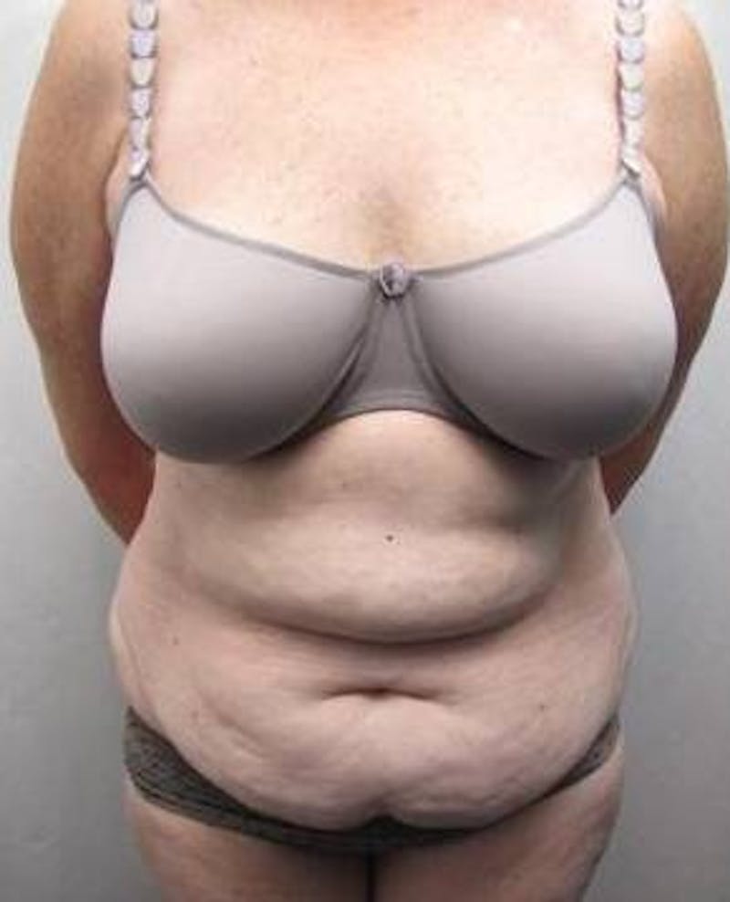 Tummy Tuck Before & After Gallery - Patient 802597 - Image 1 - Scott Chapin, MD