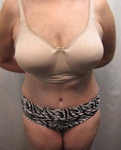 Tummy Tuck Before & After Gallery - Patient 802597 - Image 2 - Scott Chapin, MD